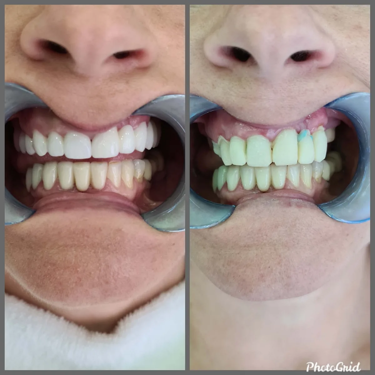 Fabrication of zirconia crowns - before and after