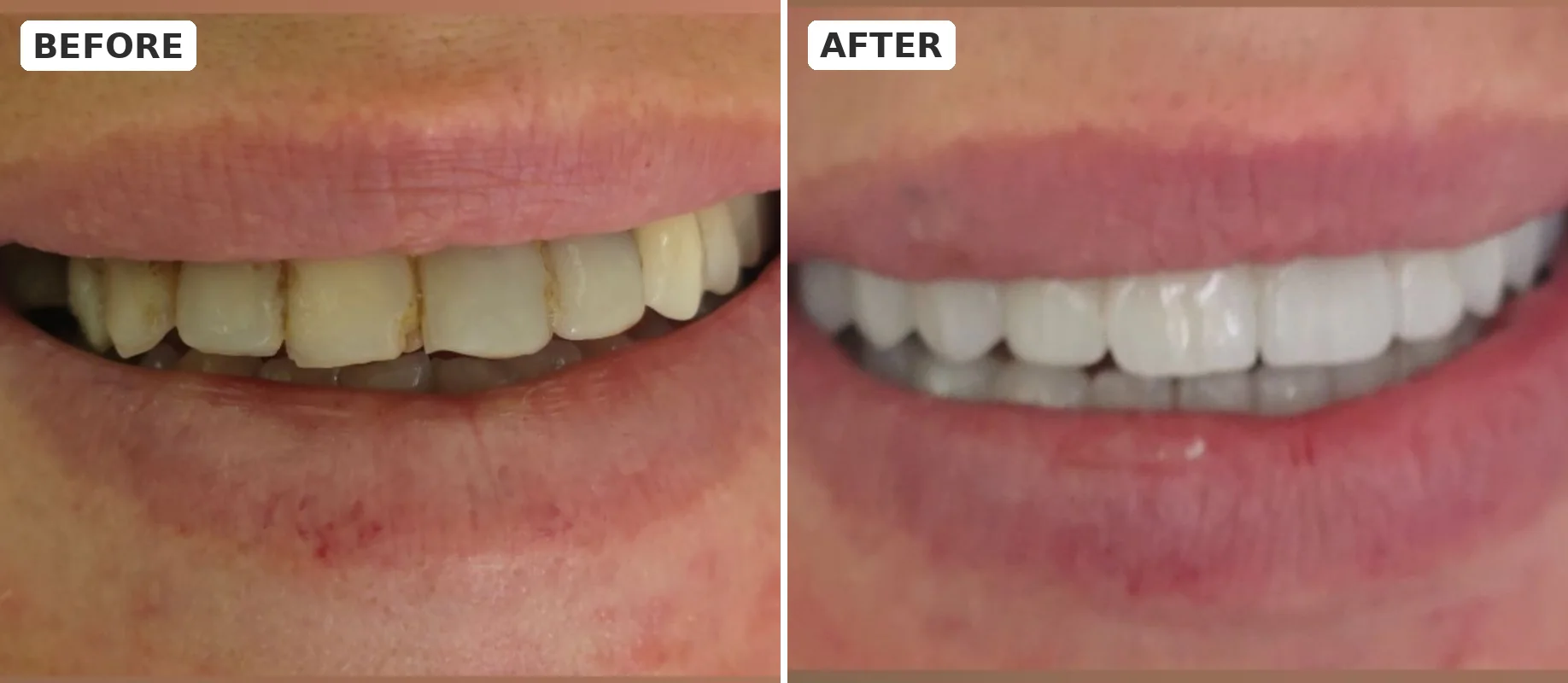 Before and after an aesthetic smile correction - Elite Dent