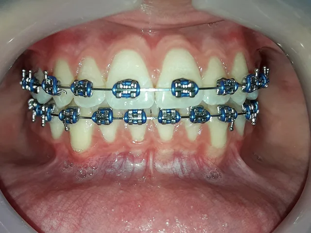Metal