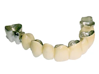 Metal-ceramic bridge