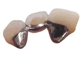 Metal hybrid bridge