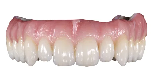 Prettau crowns
