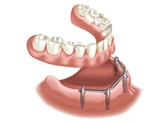 Bar-retained dentures