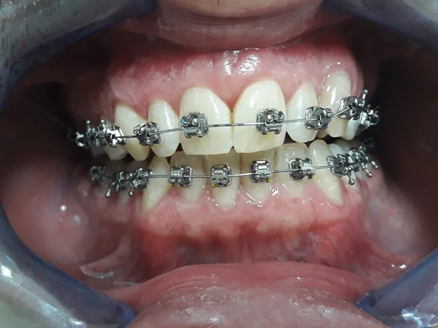 Metal