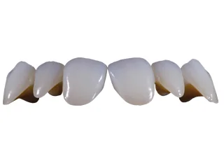 Zirconia ceramic bridge